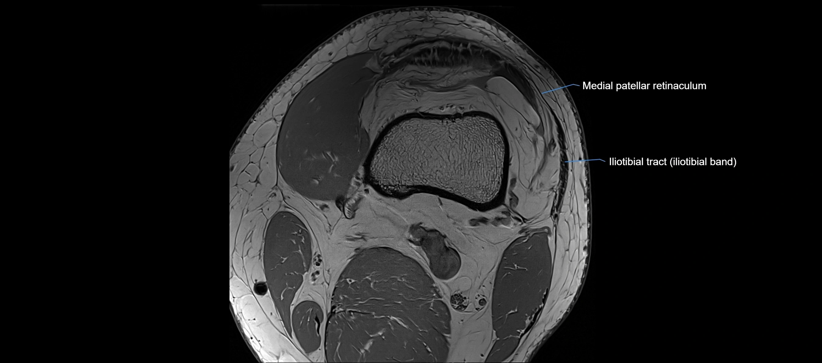 MRI Knee axial  ligaments cross sectional anatomy 3T  radiology  image-img-03001-00006.webp